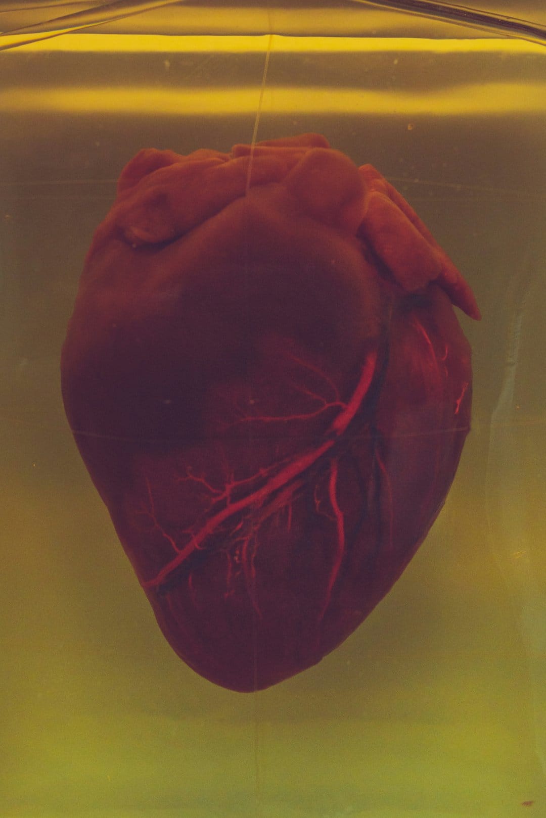Human heart specimen in yellow liquid shows a complex network of red coronary arteries and muscle tissue.